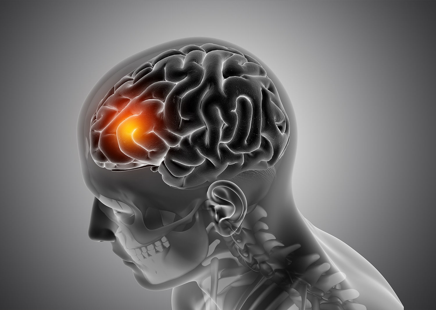 Dia Mundial de Combate ao Acidente Vascular Cerebral